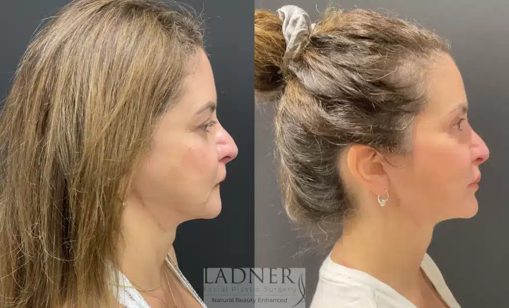 Before and After Image: Deep Plane Facelift/Neck Lift, Blepharoplasty, and Facial Fat Transfer - right-side