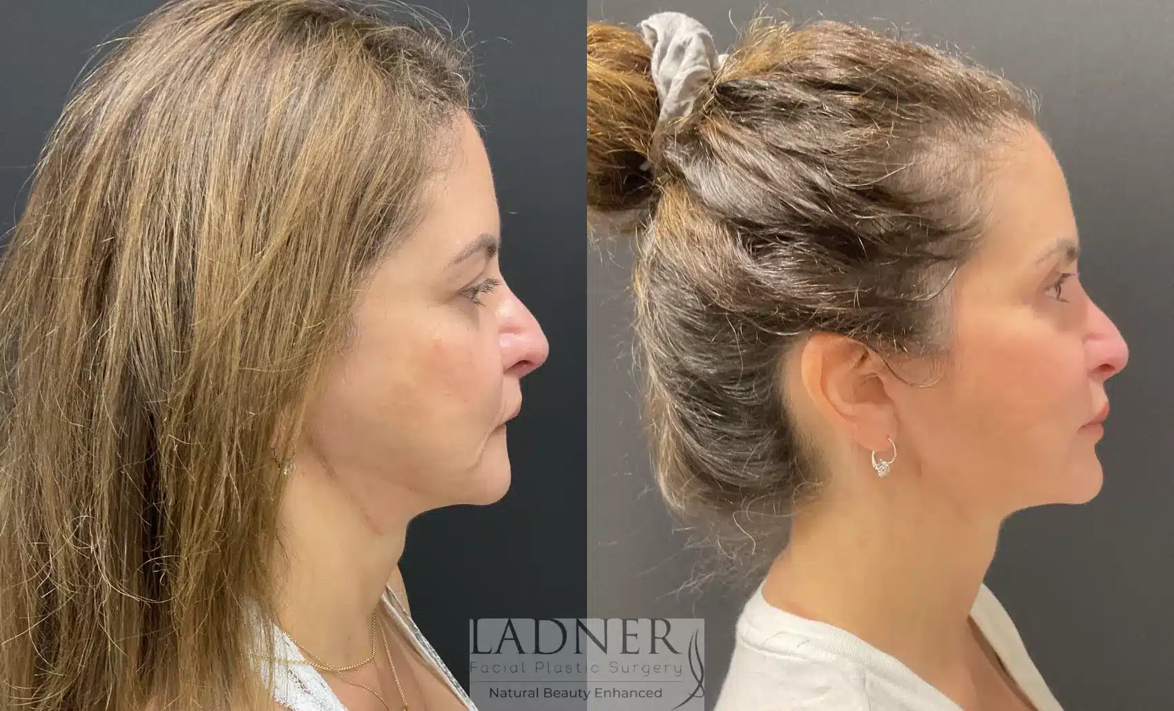 Before and After Image: Deep Plane Facelift/Neck Lift - right-side
