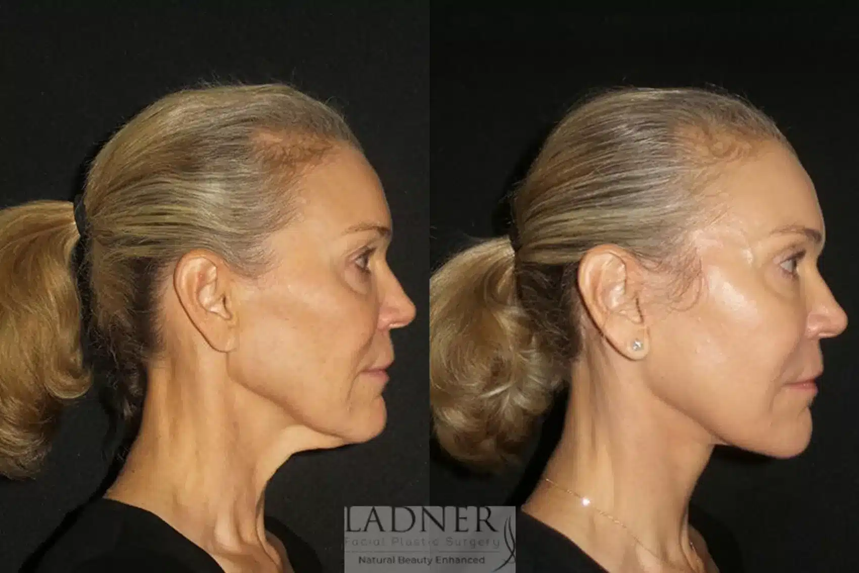 Before and After Image: Deep Plane Facelift/Neck Lift - right-side