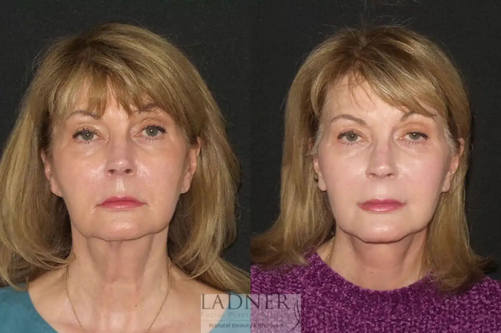 Before and After Image: Deep Plane Facelift/Neck Lift - front