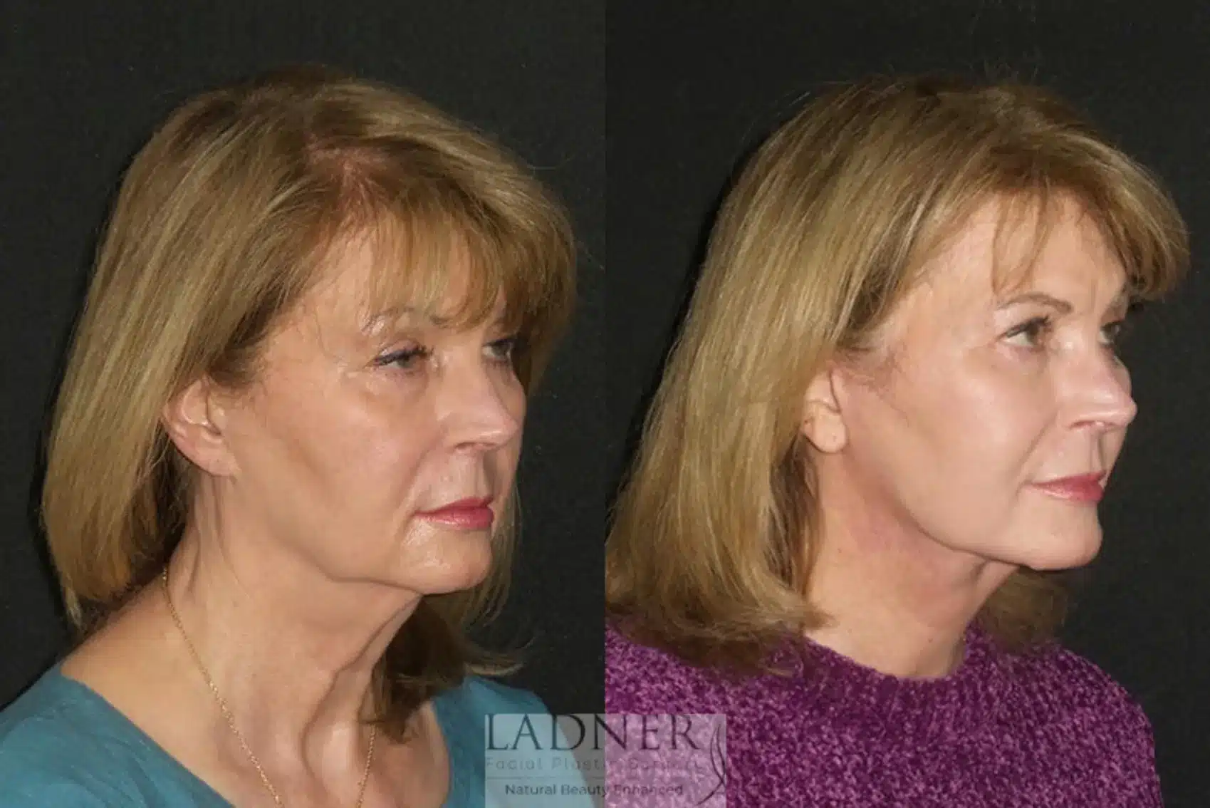 Before and After Image: Deep Plane Facelift/Neck Lift - right-front-oblique