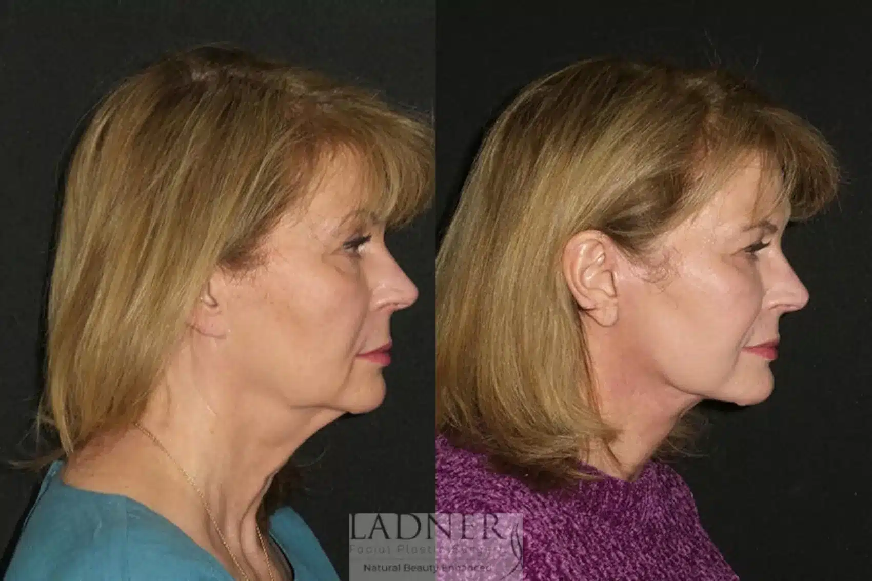 Before and After Image: Deep Plane Facelift/Neck Lift - right-side