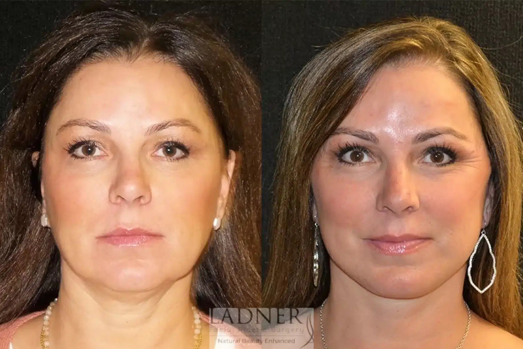 Before and After Image: Deep Plane Facelift/Neck Lift - front