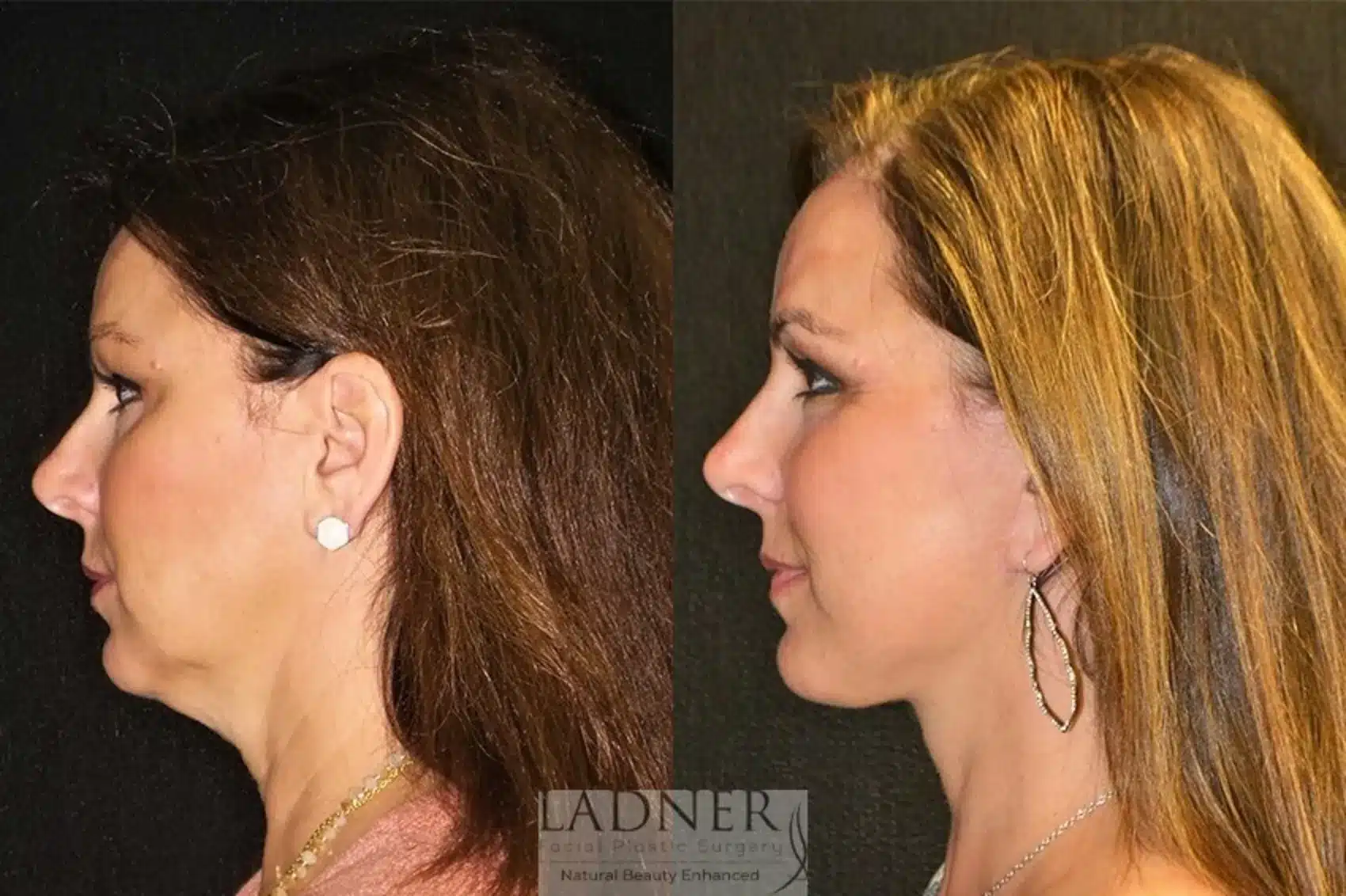 Before and After Image: Deep Plane Facelift/Neck Lift - left-side