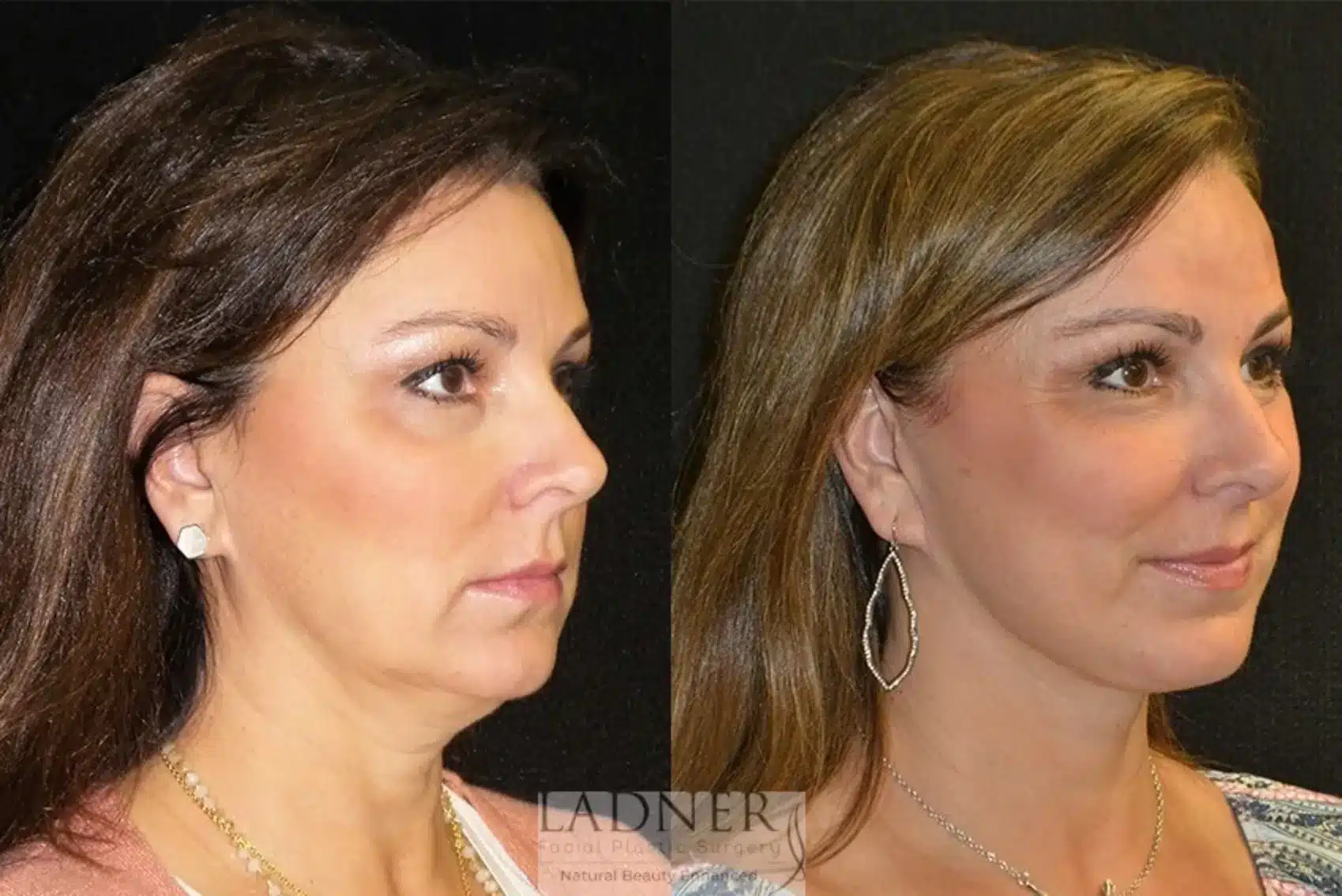 Before and After Image: Deep Plane Facelift/Neck Lift - right-front-oblique