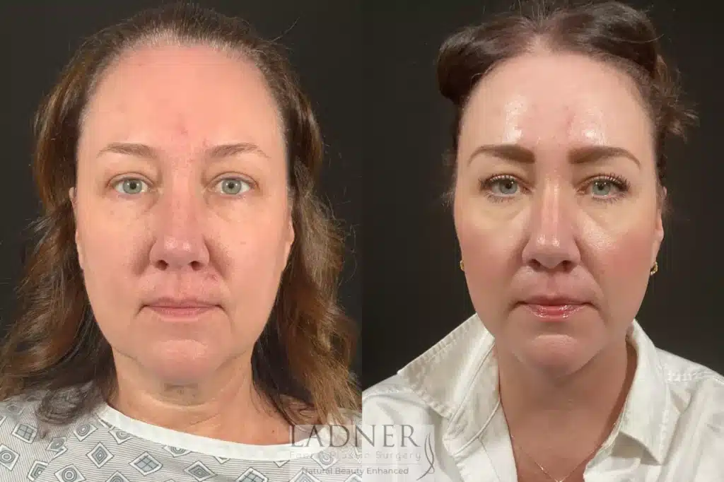 Before and After Image: Lower Deep Plane Facelift & Submental Liposuction - front