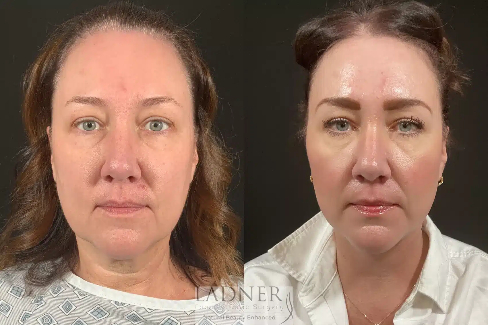 Before and After Image: Lower Deep Plane Facelift - front