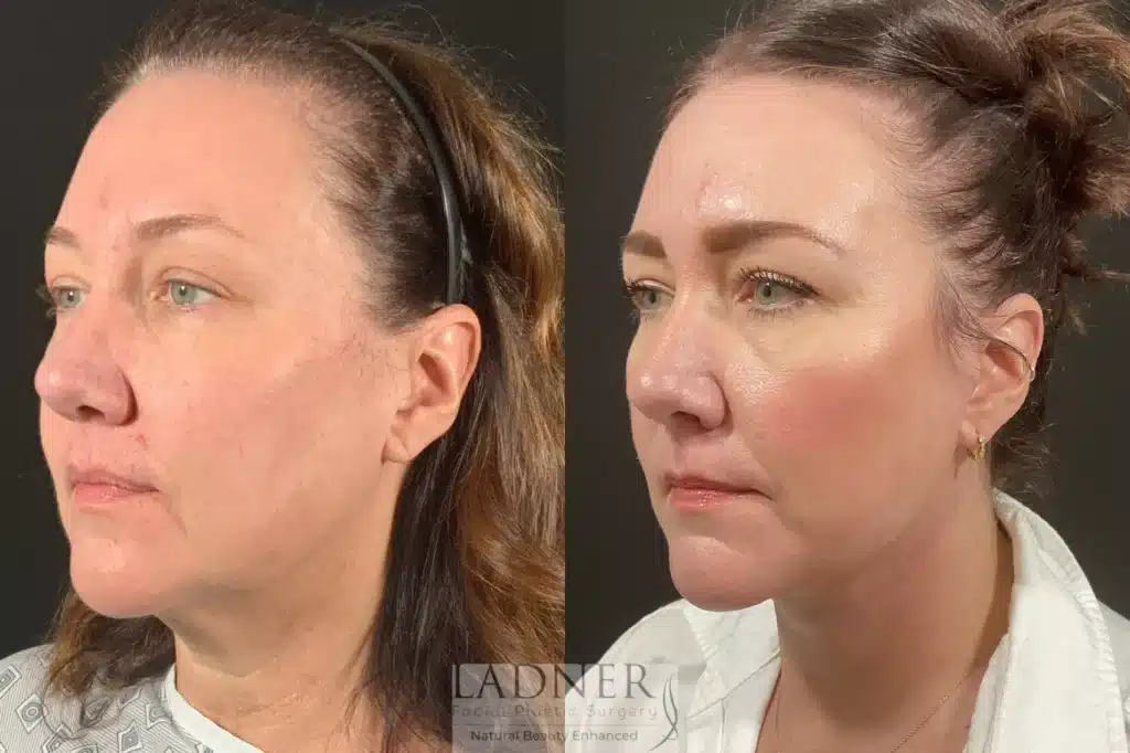 Before and After Image: Lower Deep Plane Facelift & Submental Liposuction - left-front-oblique