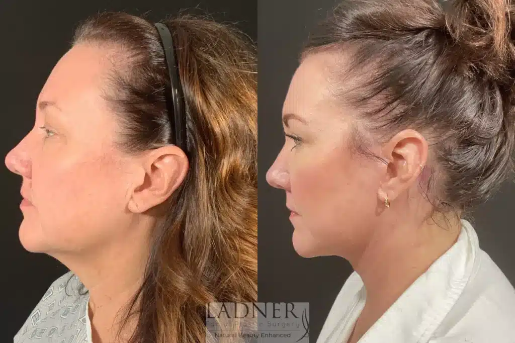 Before and After Image: Lower Deep Plane Facelift & Submental Liposuction - left-side