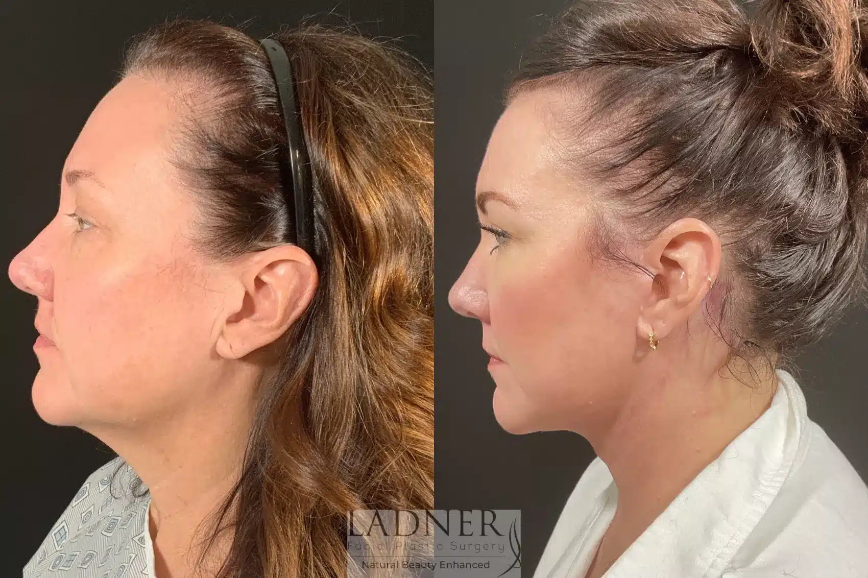 Before and After Image: Lower Deep Plane Facelift - left-side