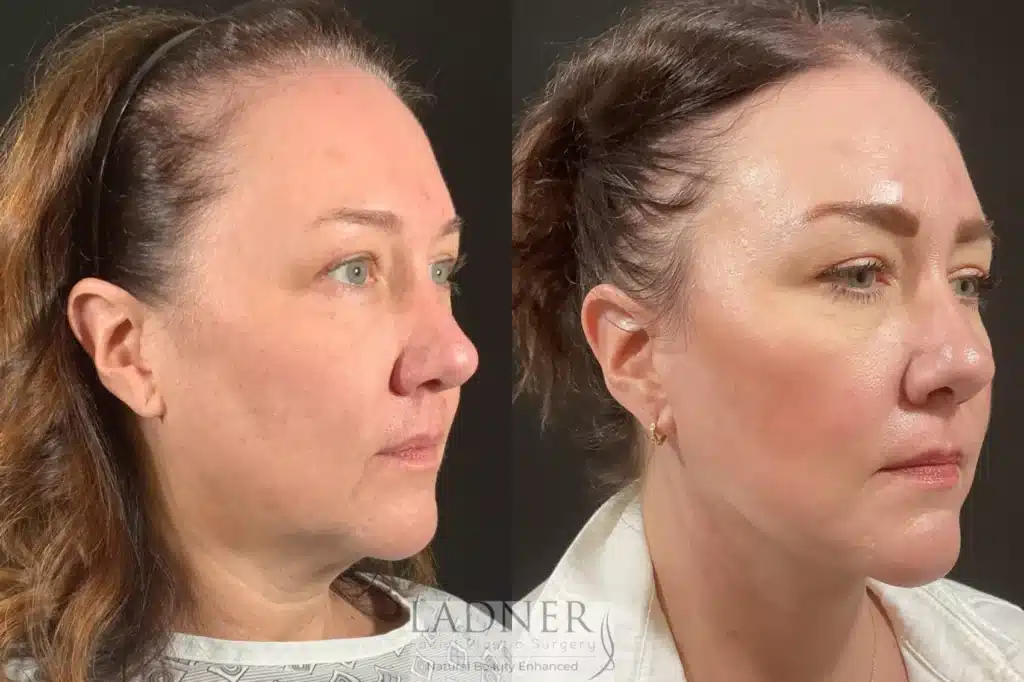 Before and After Image: Lower Deep Plane Facelift & Submental Liposuction - right-front-oblique