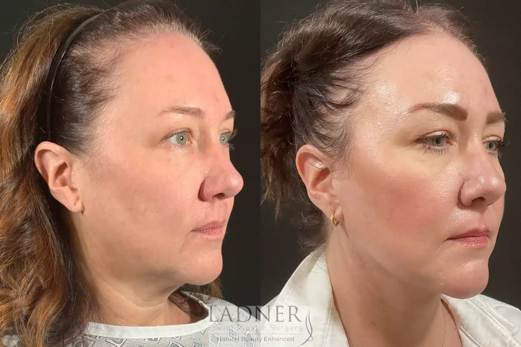Before and After Image: Lower Deep Plane Facelift - right-front-oblique