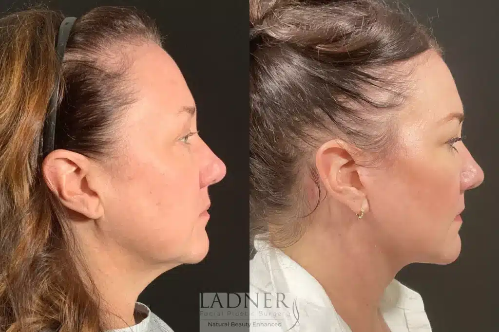 Before and After Image: Lower Deep Plane Facelift & Submental Liposuction - right-side