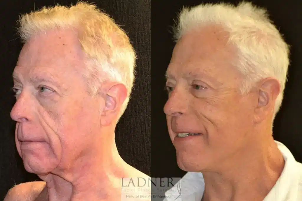 Before and After Image: Deep Plane Facelift/Neck Lift, Blepharoplasty, and Facial Plastic Surgery for Men - left-front-oblique