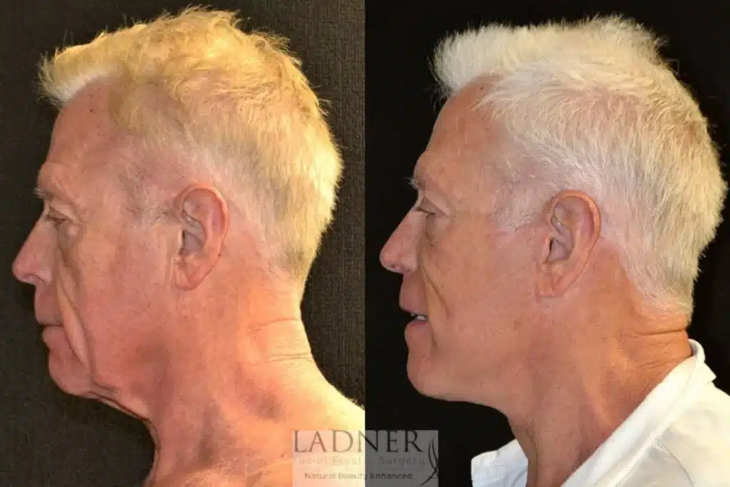 Before and After Image: Deep Plane Facelift/Neck Lift, Blepharoplasty, and Facial Plastic Surgery for Men - left-side