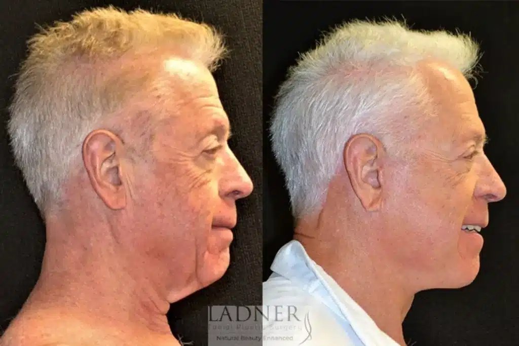Before and After Image: Deep Plane Facelift/Neck Lift, Blepharoplasty, and Facial Plastic Surgery for Men - right-side