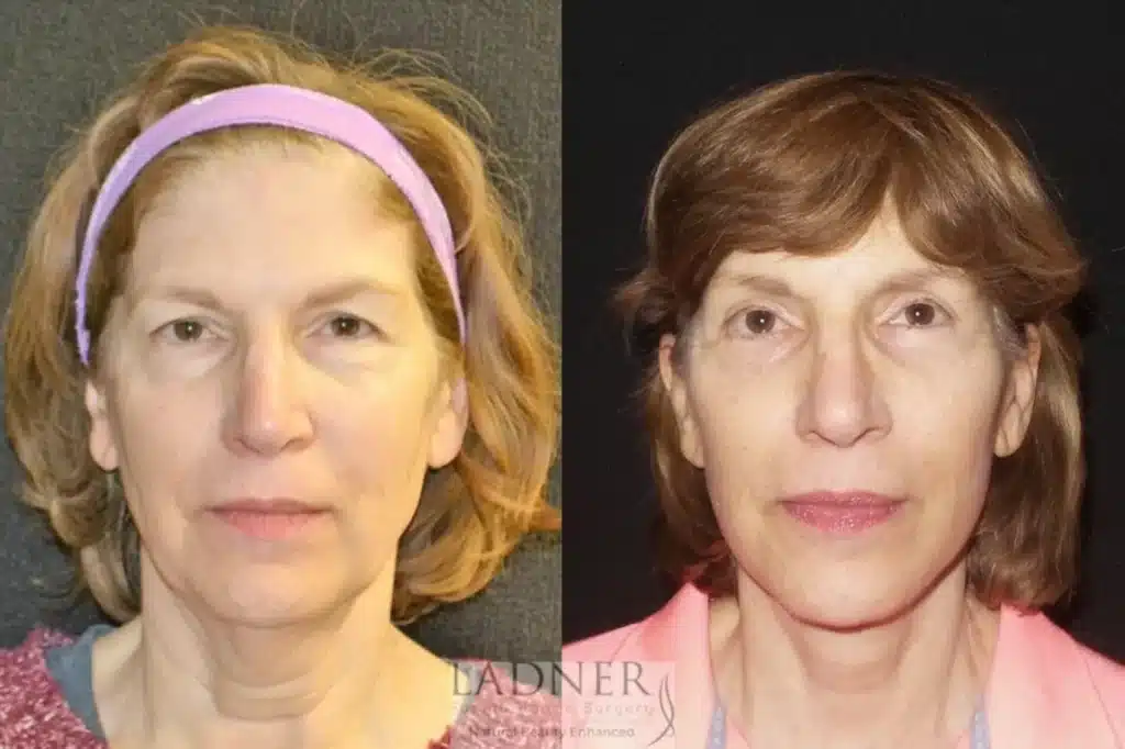 Before and After Image: Deep Plane Facelift, Blepharoplasty, and Brow Lift/Forehead Lift - front
