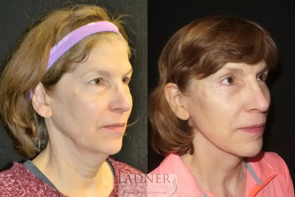 Before and After Image: Deep Plane Facelift, Blepharoplasty, and Brow Lift/Forehead Lift - right-front-oblique