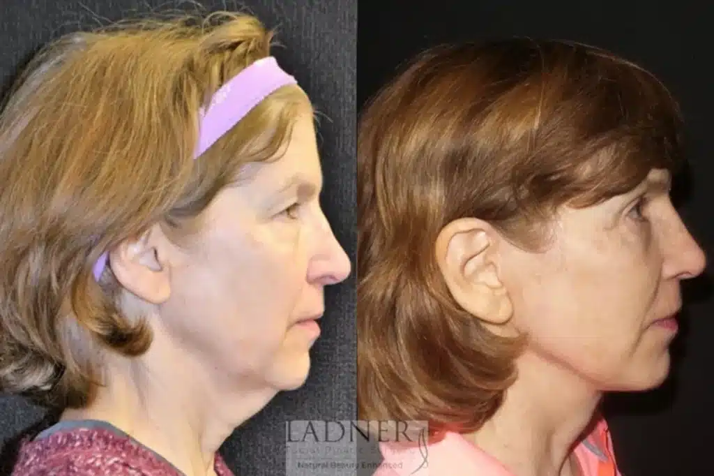 Before and After Image: Deep Plane Facelift, Blepharoplasty, and Brow Lift/Forehead Lift - right-side
