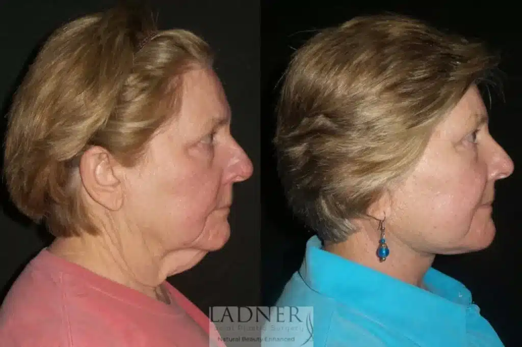Before and After Image: Deep Plane Facelift/Neck Lift & Brow Lift/Forhead Lift - right-side