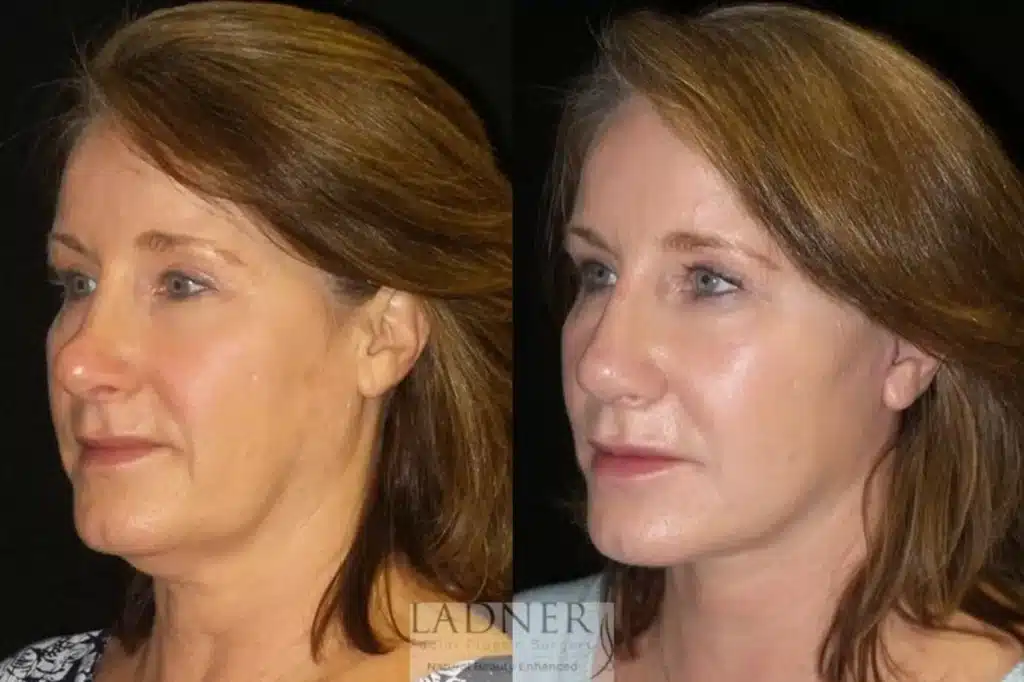Before and After Image: Deep Plane Facelift/Neck Lift - left-front-oblique