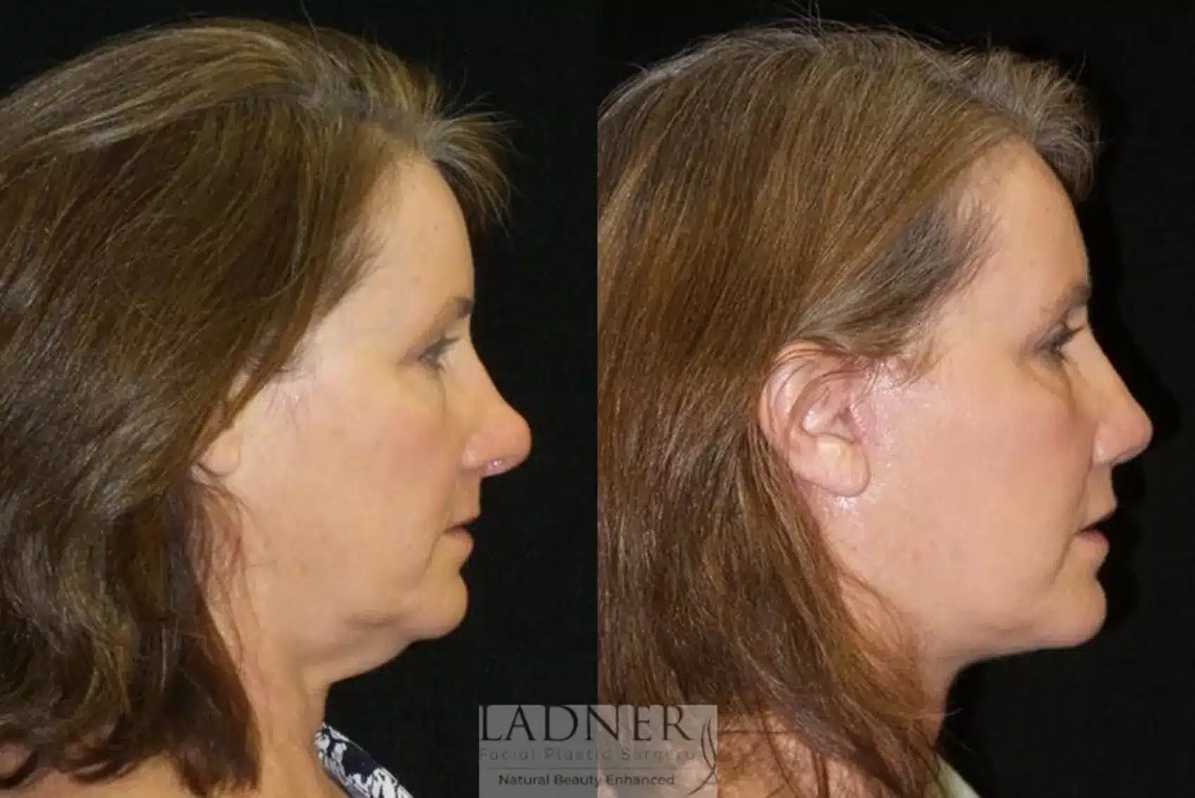 Before and After Image: Deep Plane Facelift/Neck Lift - right-side