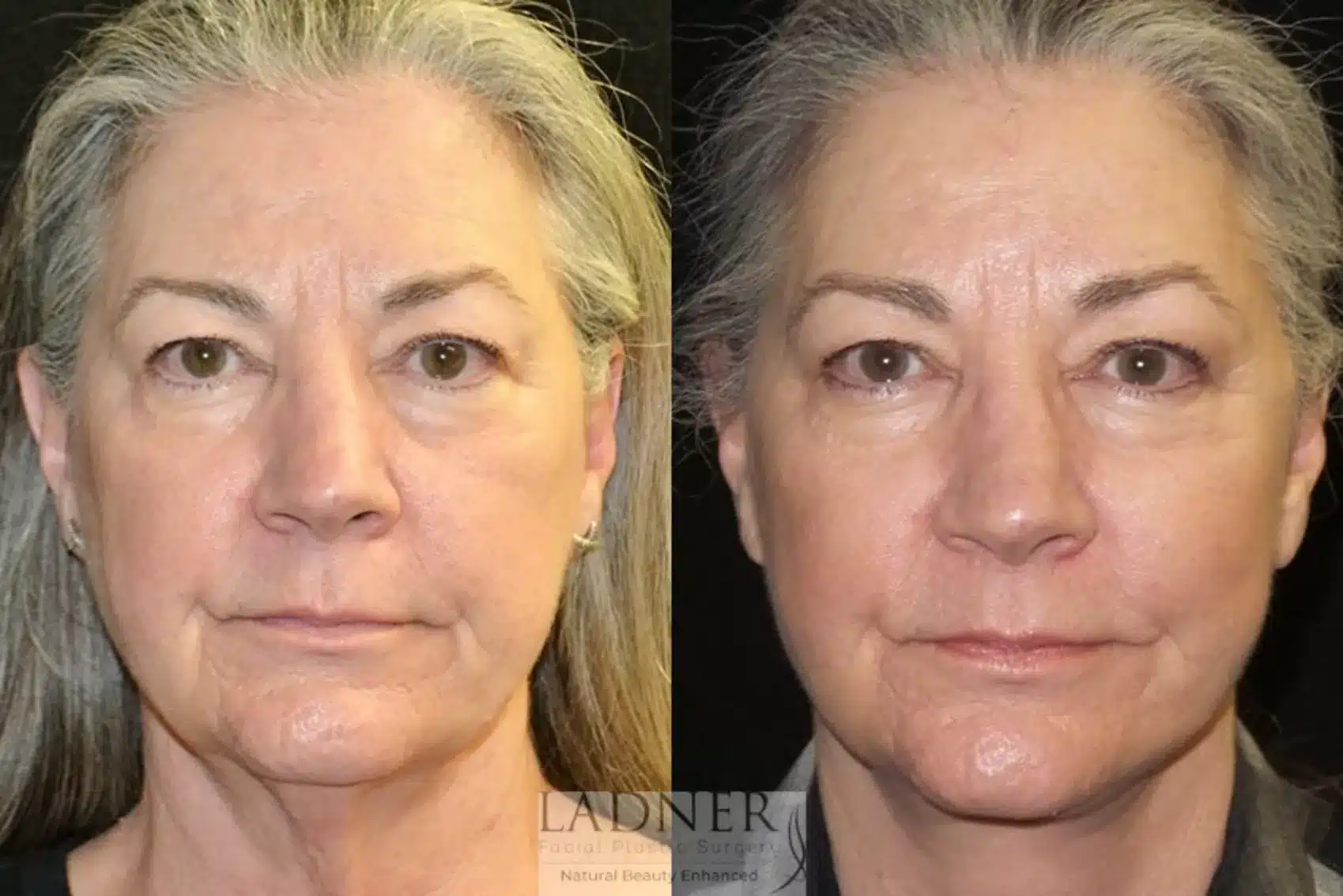 Before and After Image: Deep Plane Neck Lift - front