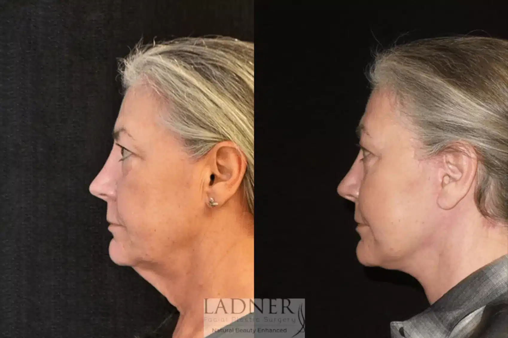 Before and After Image: Deep Plane Neck Lift - left-side