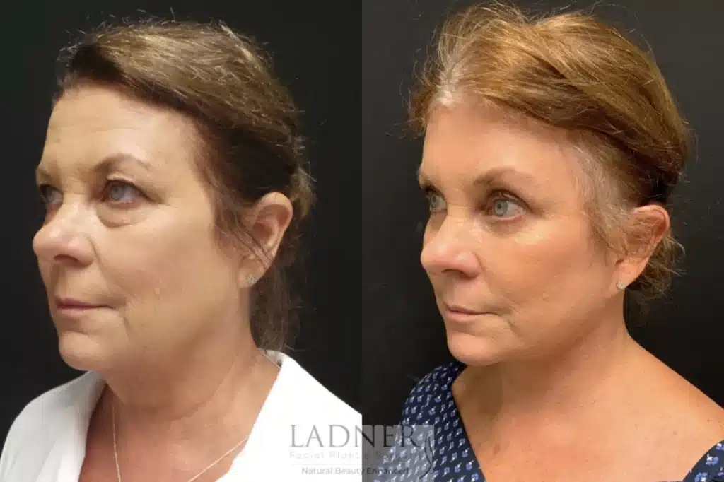 Before and After Image: Deep Plane Facelift/Neck Lift, Blepharoplasty, and Brow Lift/Forehead Lift - left-front-oblique