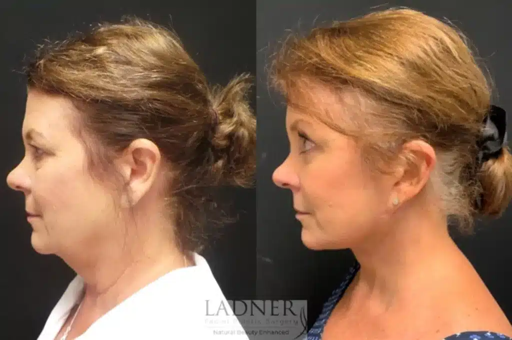 Before and After Image: Deep Plane Facelift/Neck Lift, Blepharoplasty, and Brow Lift/Forehead Lift - left-side