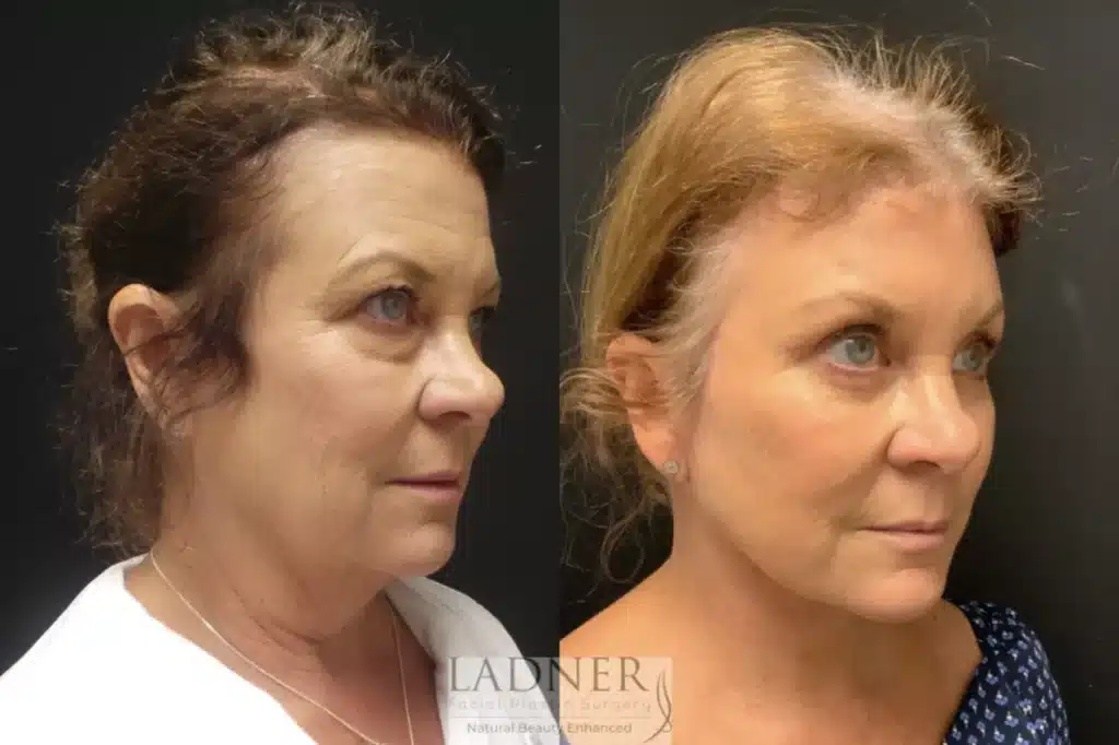 Before and After Image: Deep Plane Facelift/Neck Lift, Blepharoplasty, and Brow Lift/Forehead Lift - right-front-oblique
