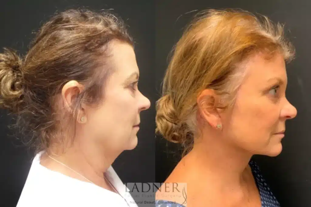 Before and After Image: Deep Plane Facelift/Neck Lift, Blepharoplasty, and Brow Lift/Forehead Lift - right-side