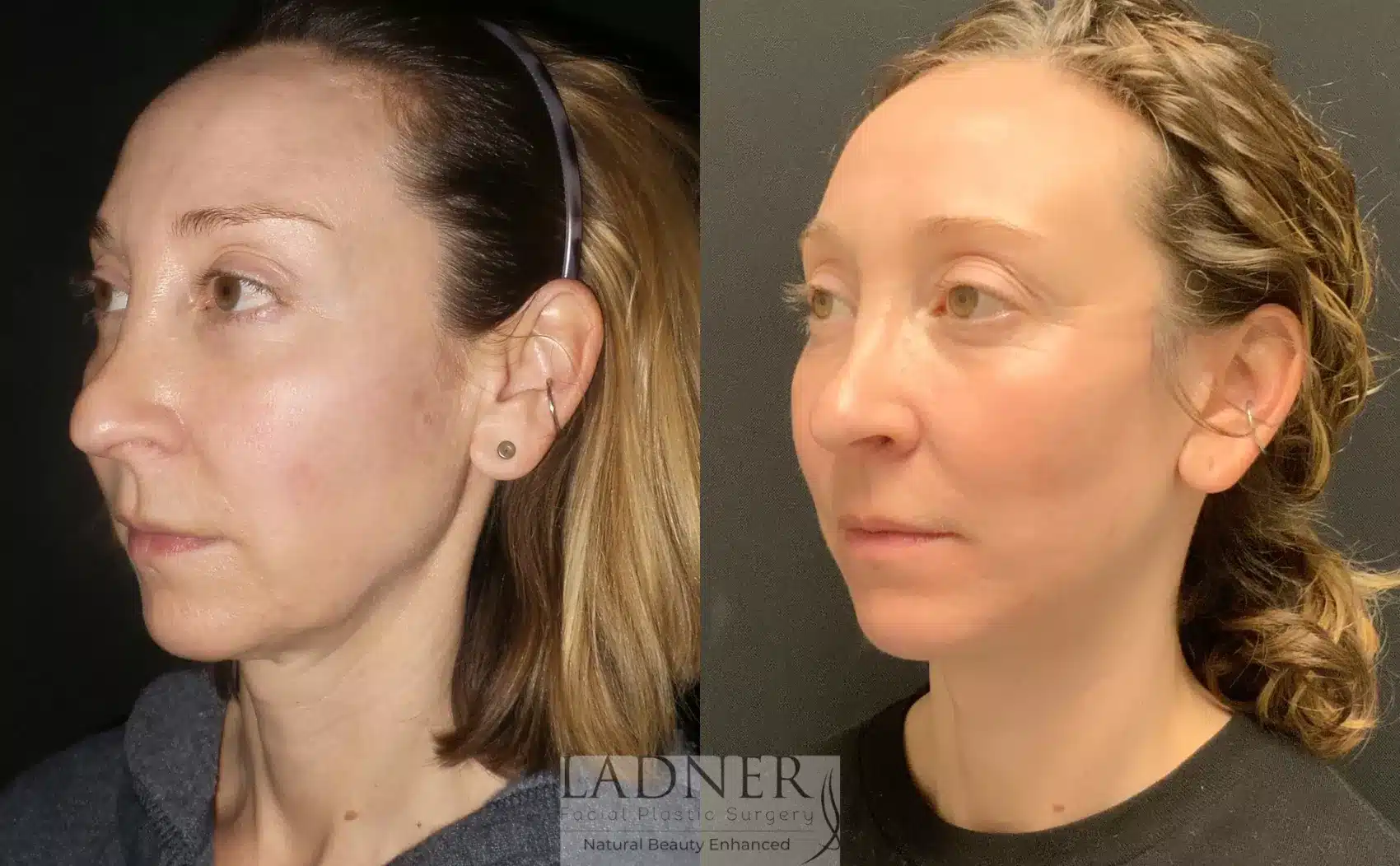 Before and After Image: Deep Plane Facelift/Neck Lift - left-front-oblique