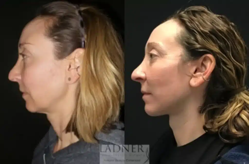 Before and After Image: Deep Plane Facelift/Neck Lift - left-side