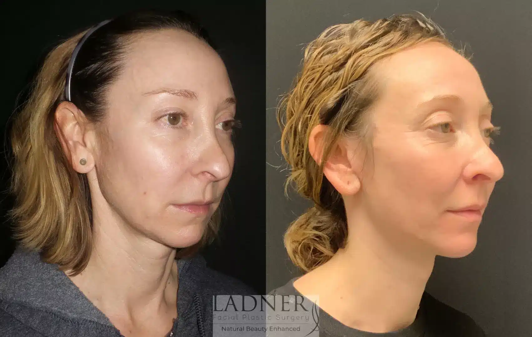Before and After Image: Deep Plane Facelift/Neck Lift - right-front-oblique