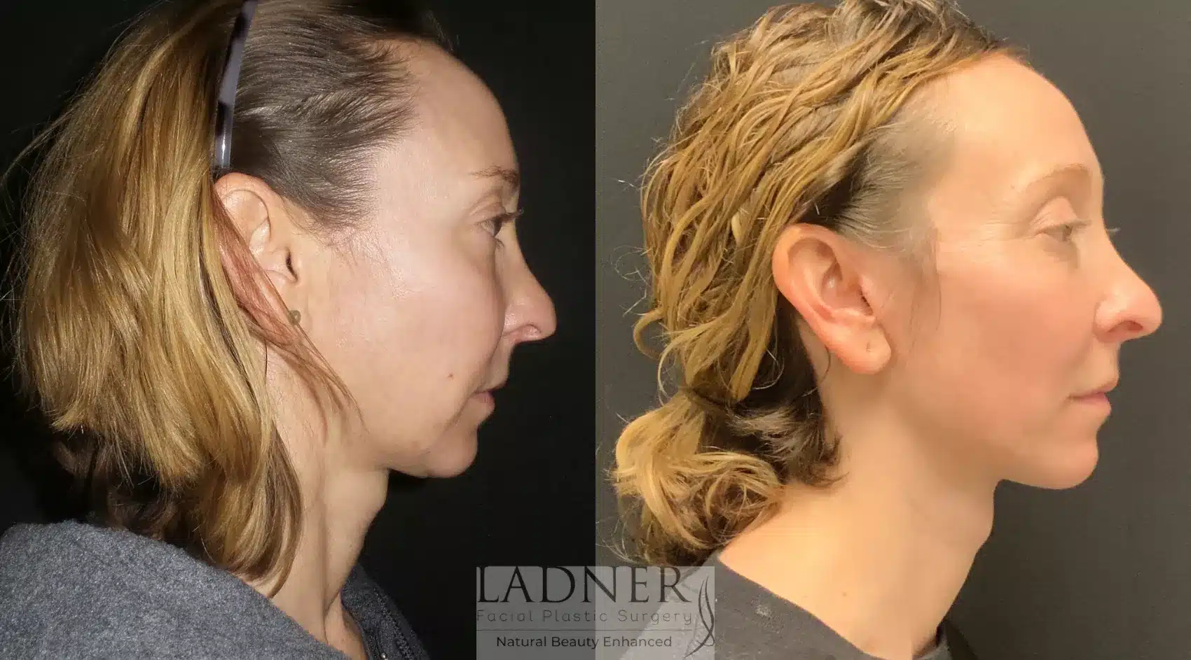 Before and After Image: Deep Plane Facelift/Neck Lift - right-side