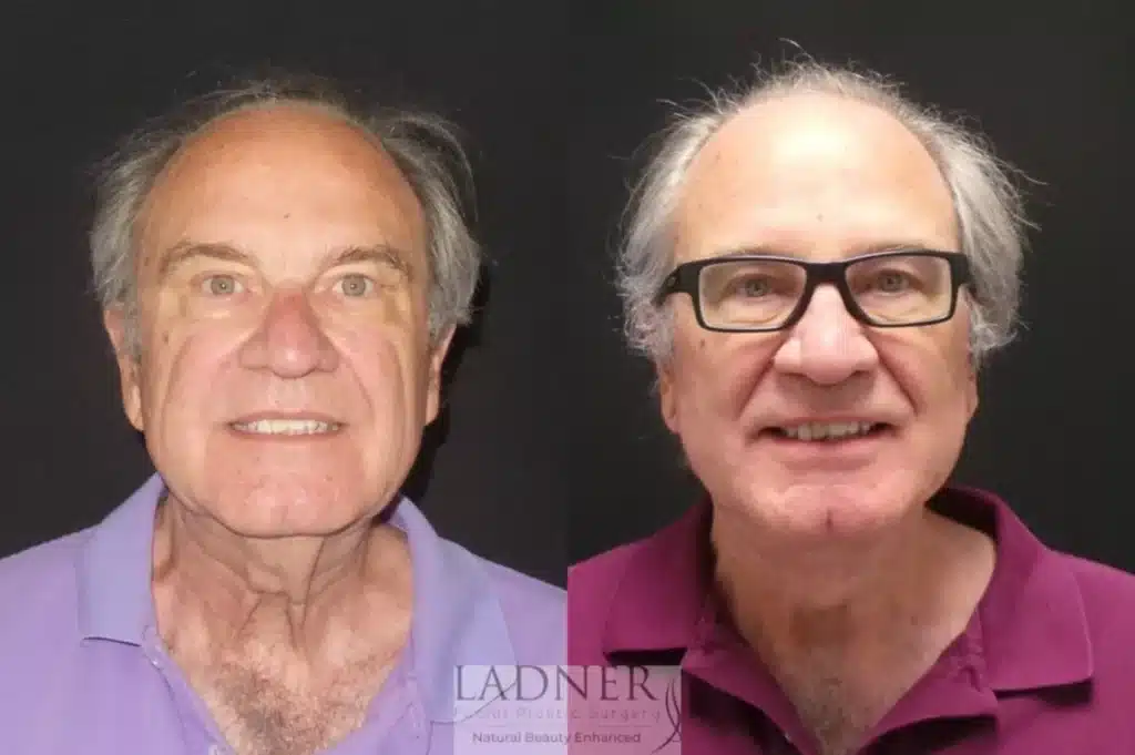 Before and After Image: Lower Deep Plane Facelift/Neck Lift & Facial Plastic Surgery for Men - front