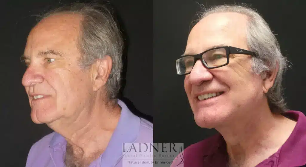 Before and After Image: Lower Deep Plane Facelift/Neck Lift & Facial Plastic Surgery for Men - left-front-oblique