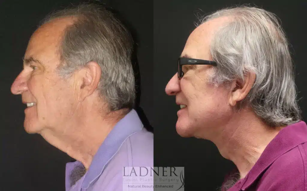Before and After Image: Lower Deep Plane Facelift/Neck Lift & Facial Plastic Surgery for Men - left-side