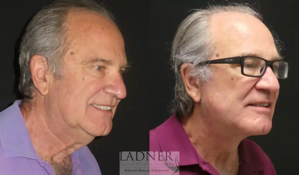 Before and After Image: Lower Deep Plane Facelift/Neck Lift & Facial Plastic Surgery for Men - right-front-oblique