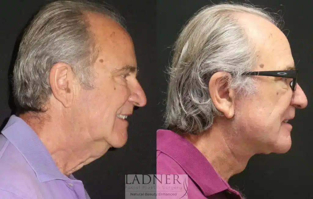 Before and After Image: Lower Deep Plane Facelift/Neck Lift & Facial Plastic Surgery for Men - right-side