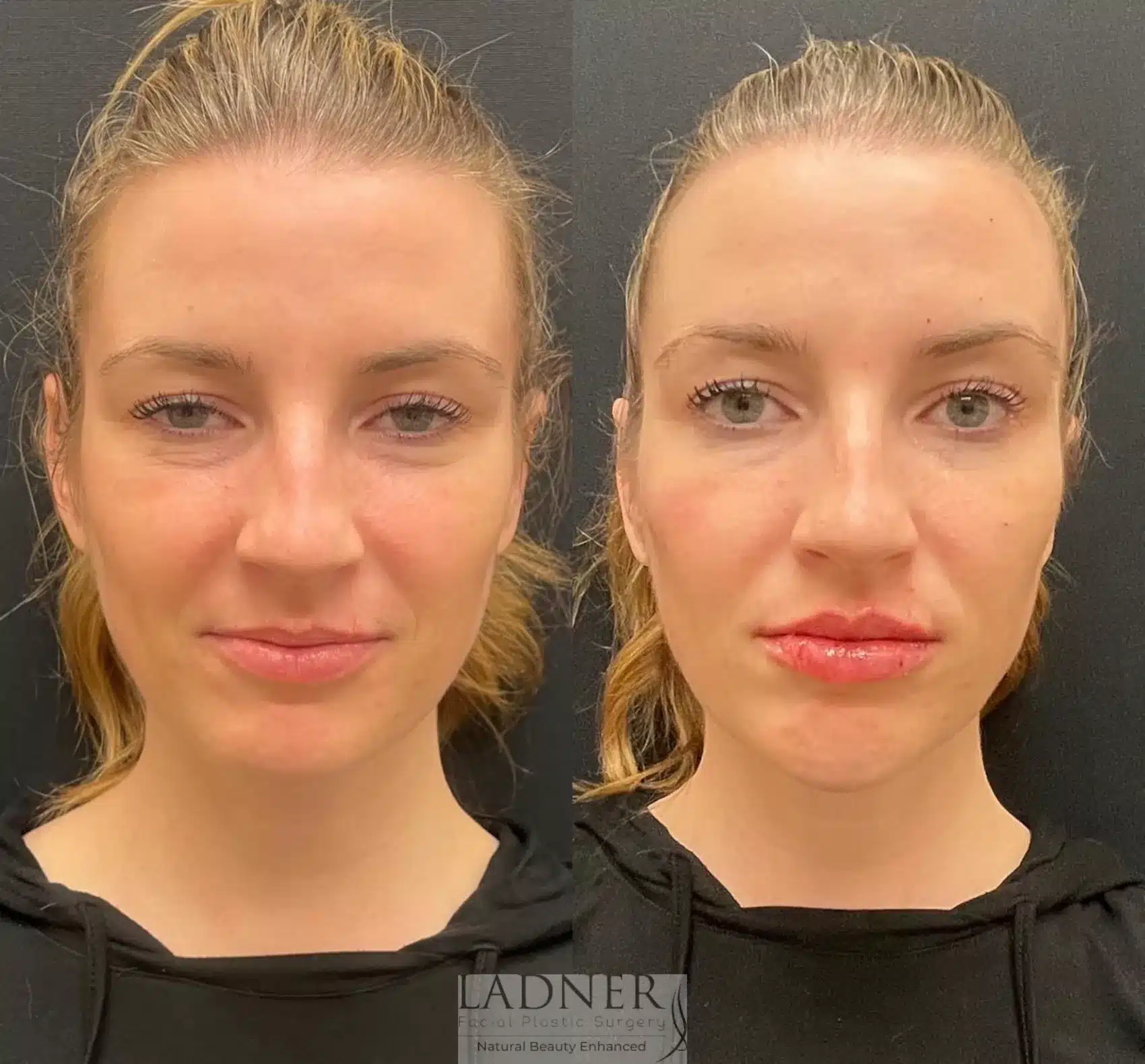 Before and After Image: Facial Balancing - front