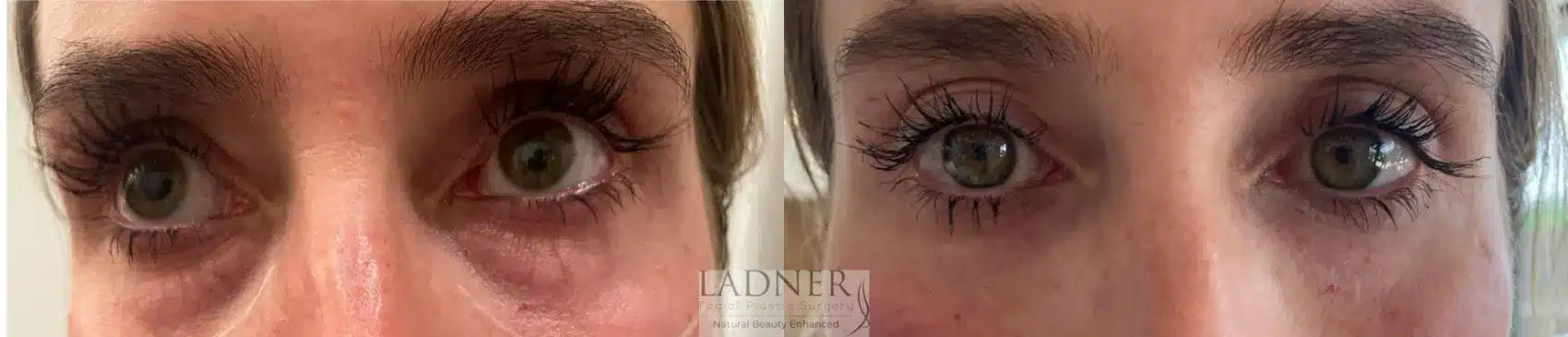 Before and After Image: Facial Balancing - front