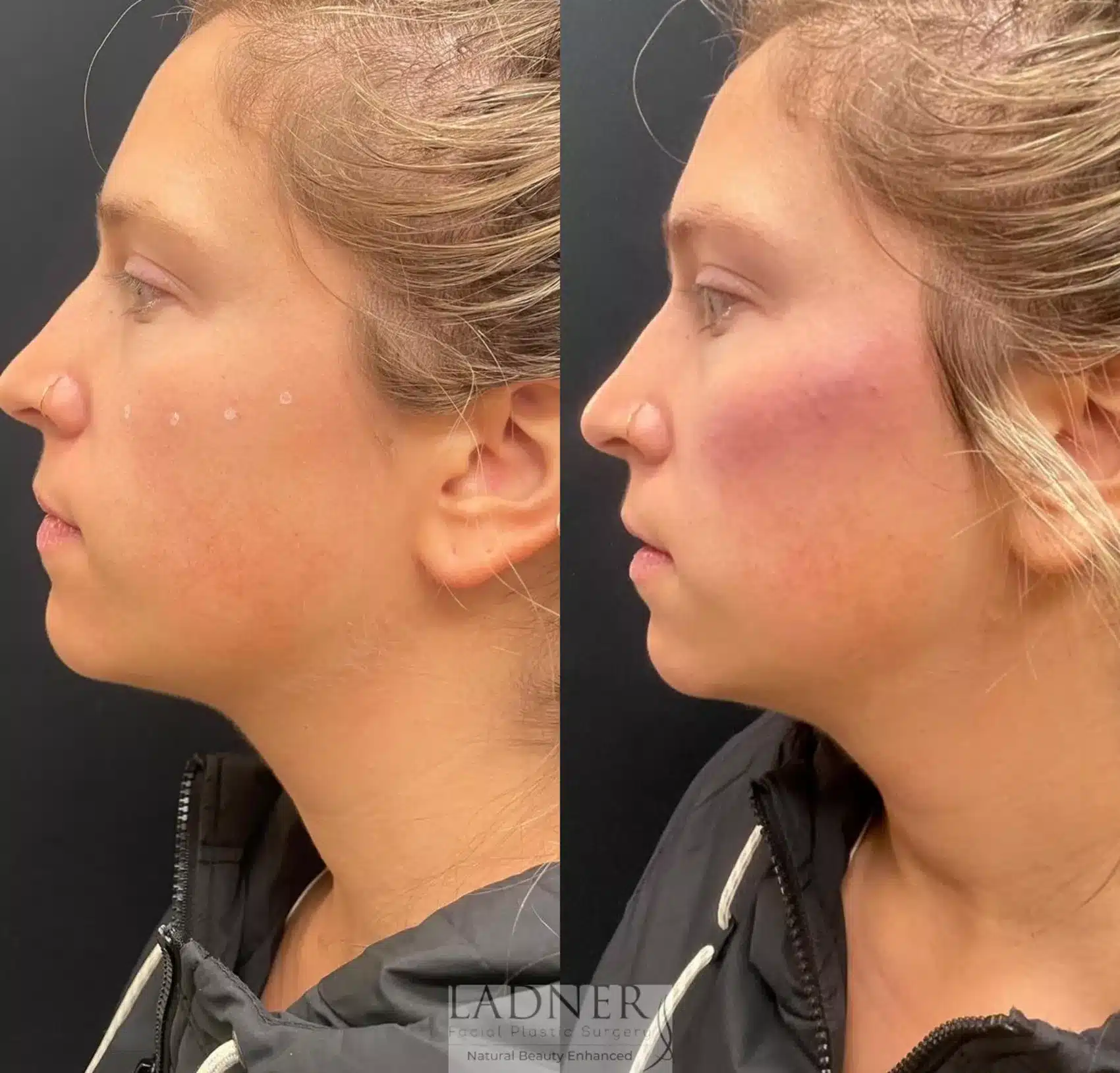 Before and After Image: Facial Balancing - left-side