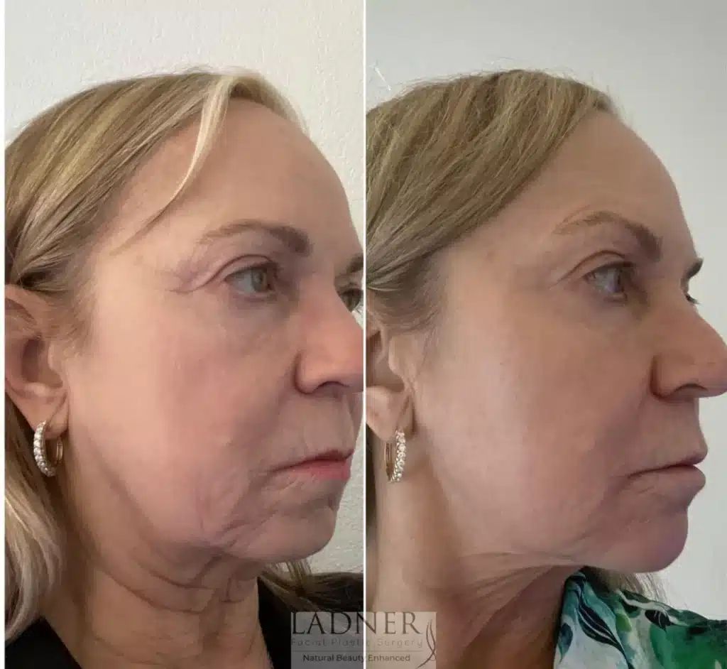 Before and After Image: Facial Balancing - right-front-oblique