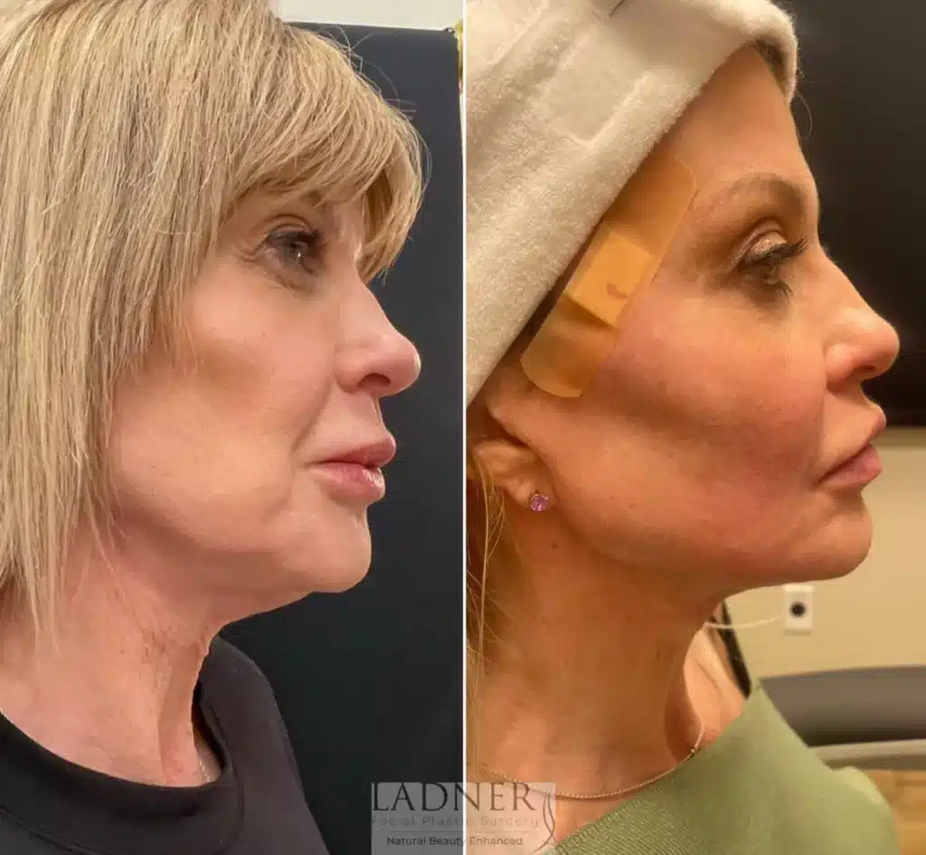 Before and After Image: Facial Balancing - right-side