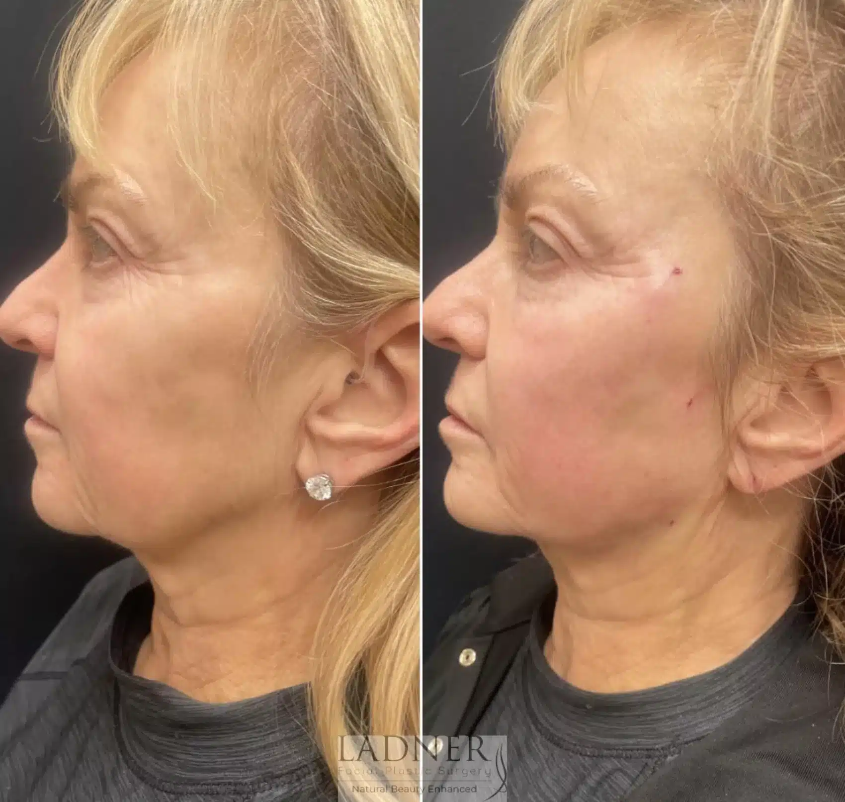 Before and After Image: Facial Balancing - left-side