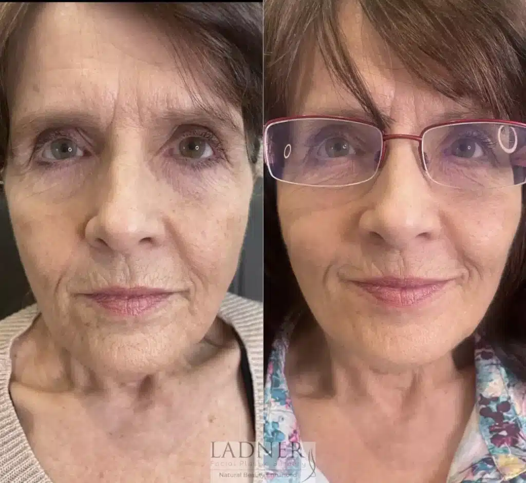 Before and After Image: Facial Balancing - front
