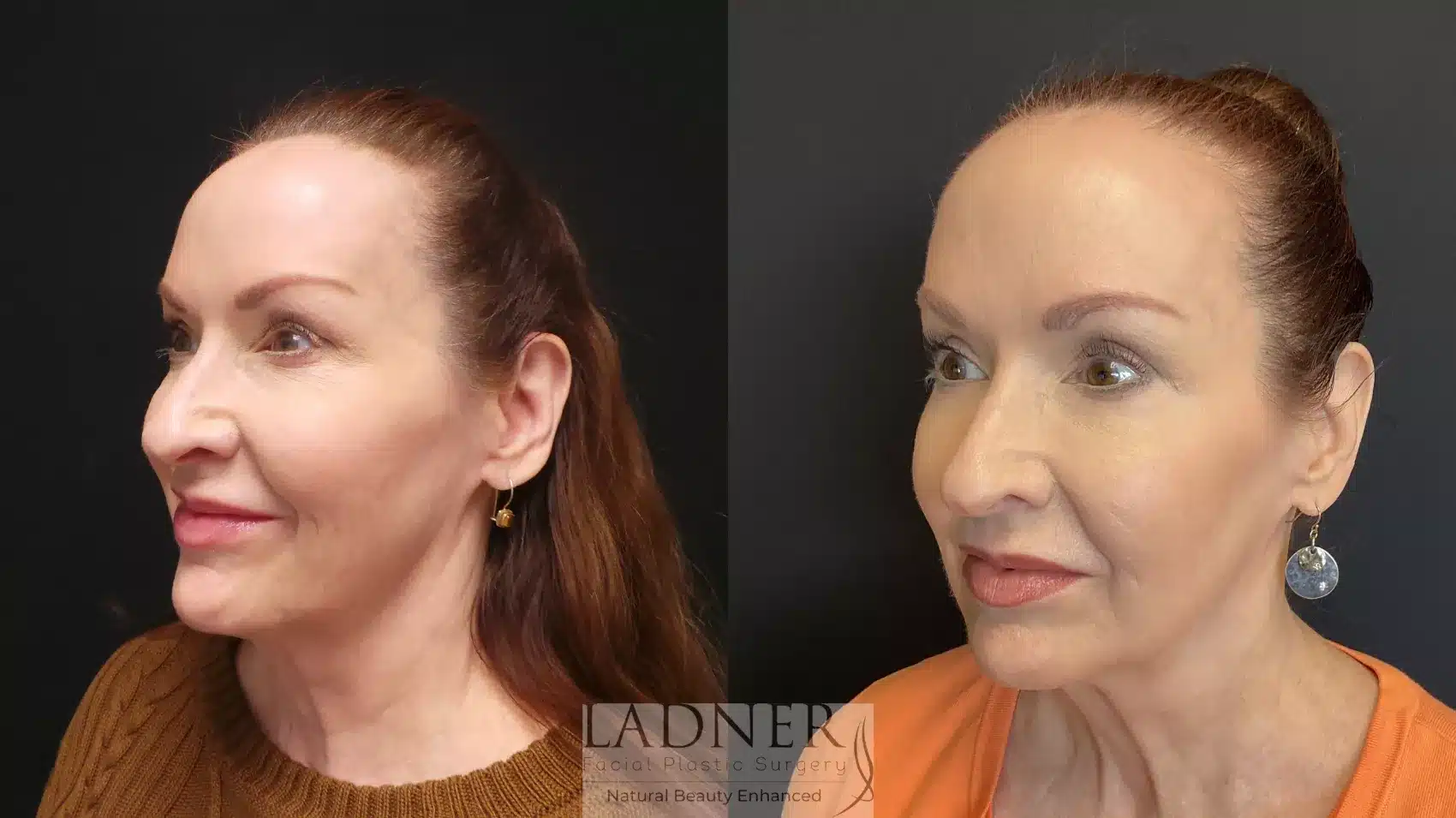 Before and After Image: Facial Fat Transfer - left-front-oblique