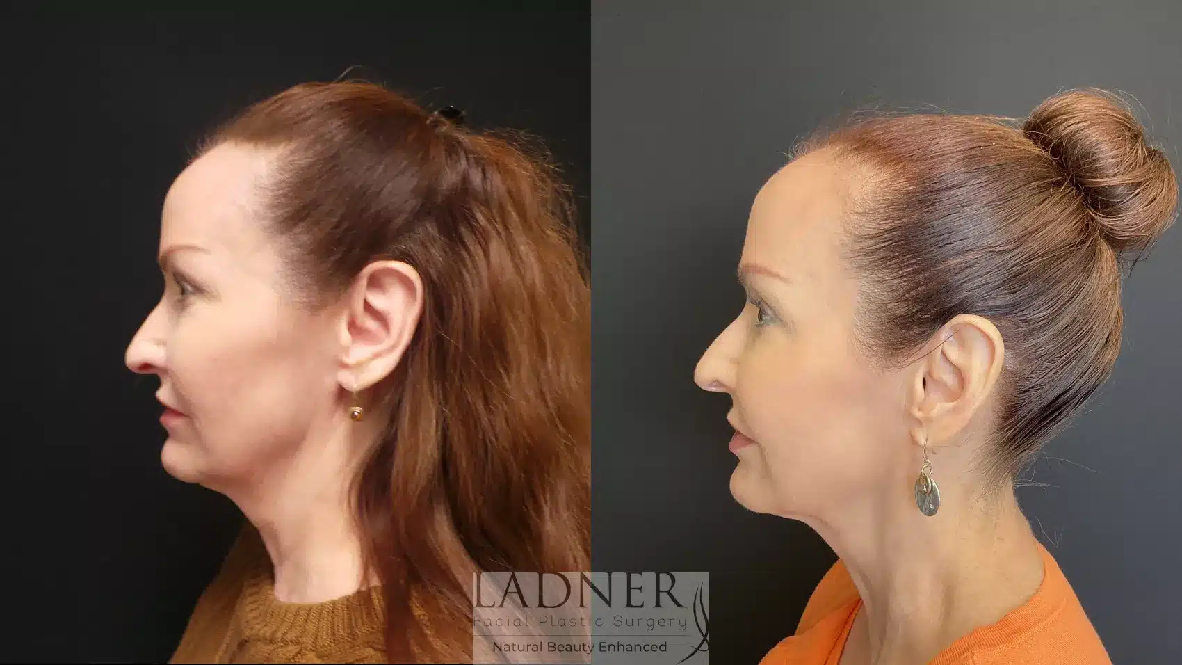 Before and After Image: Facial Fat Transfer - left-side